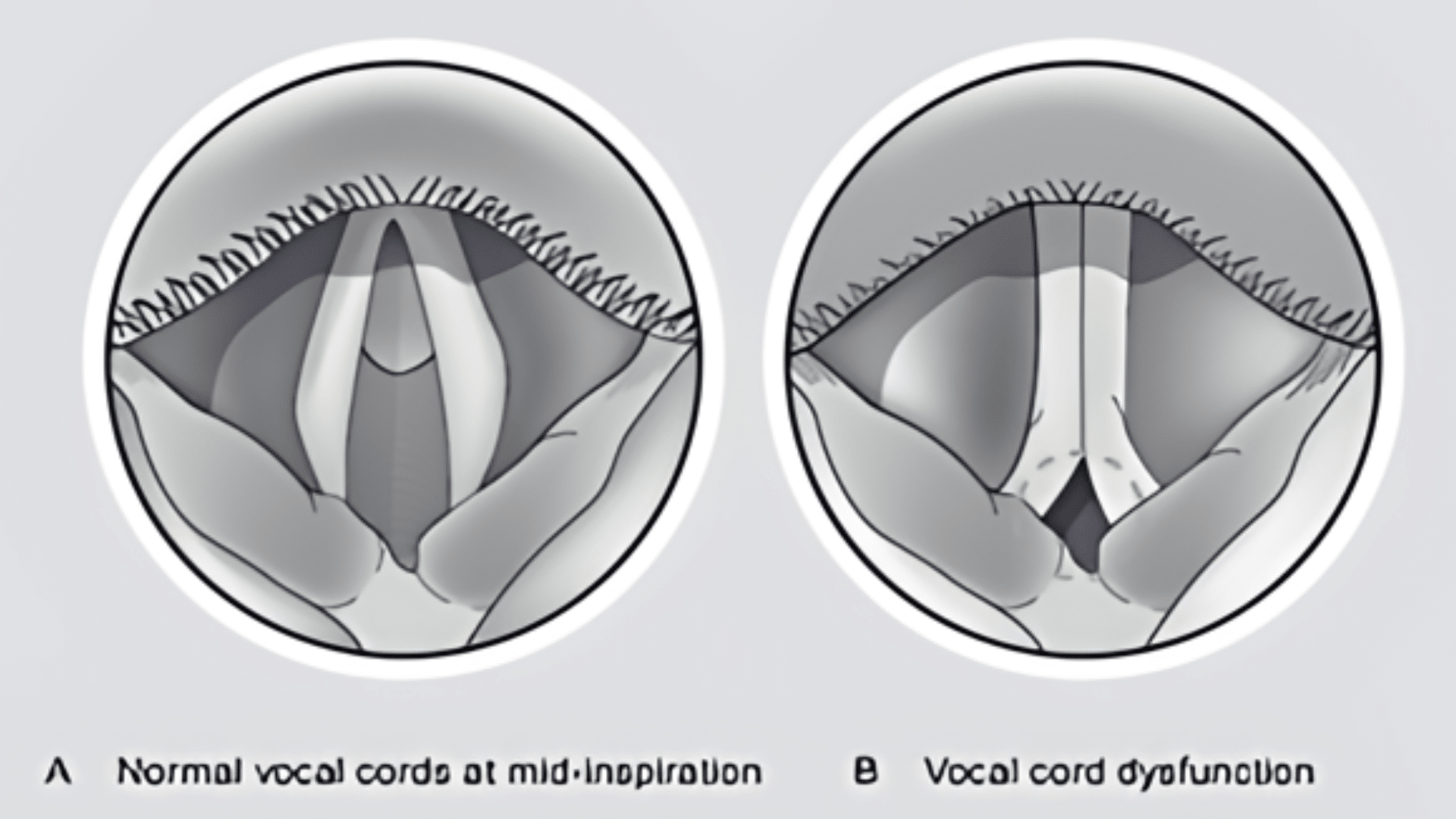 What_is_Vocal_Cord_Dysfunction