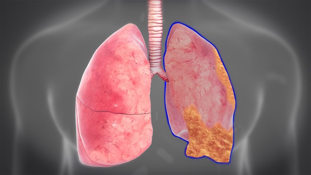 Mesothelioma Diagnosis