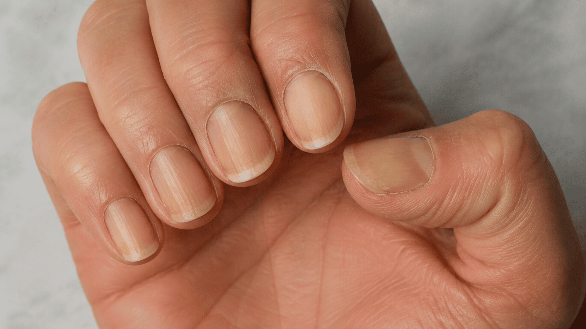 Close-up of a hand showing fingernails with yellow tips and mild discoloration.