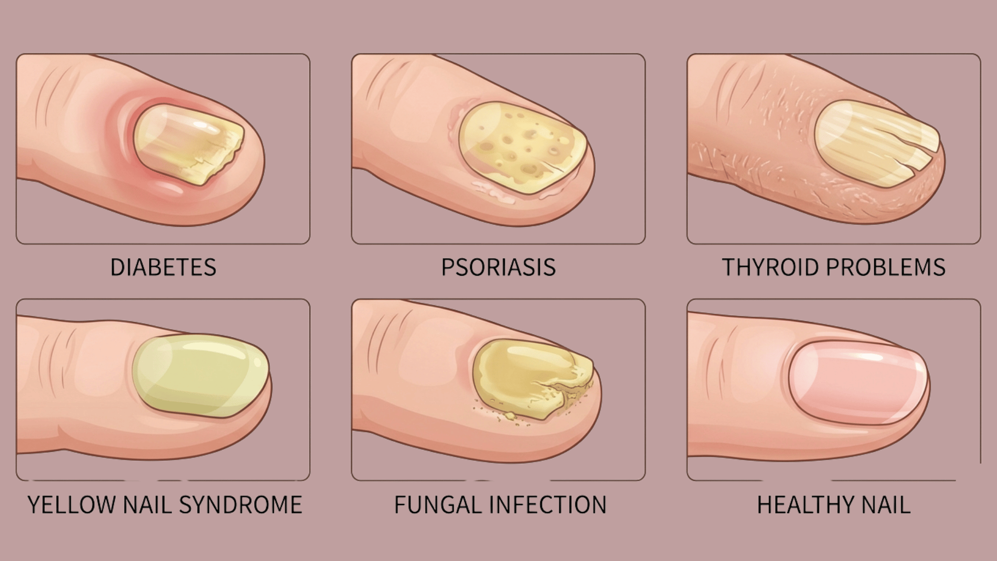 Six-panel medical illustration comparing various yellow nail conditions and a healthy nail.