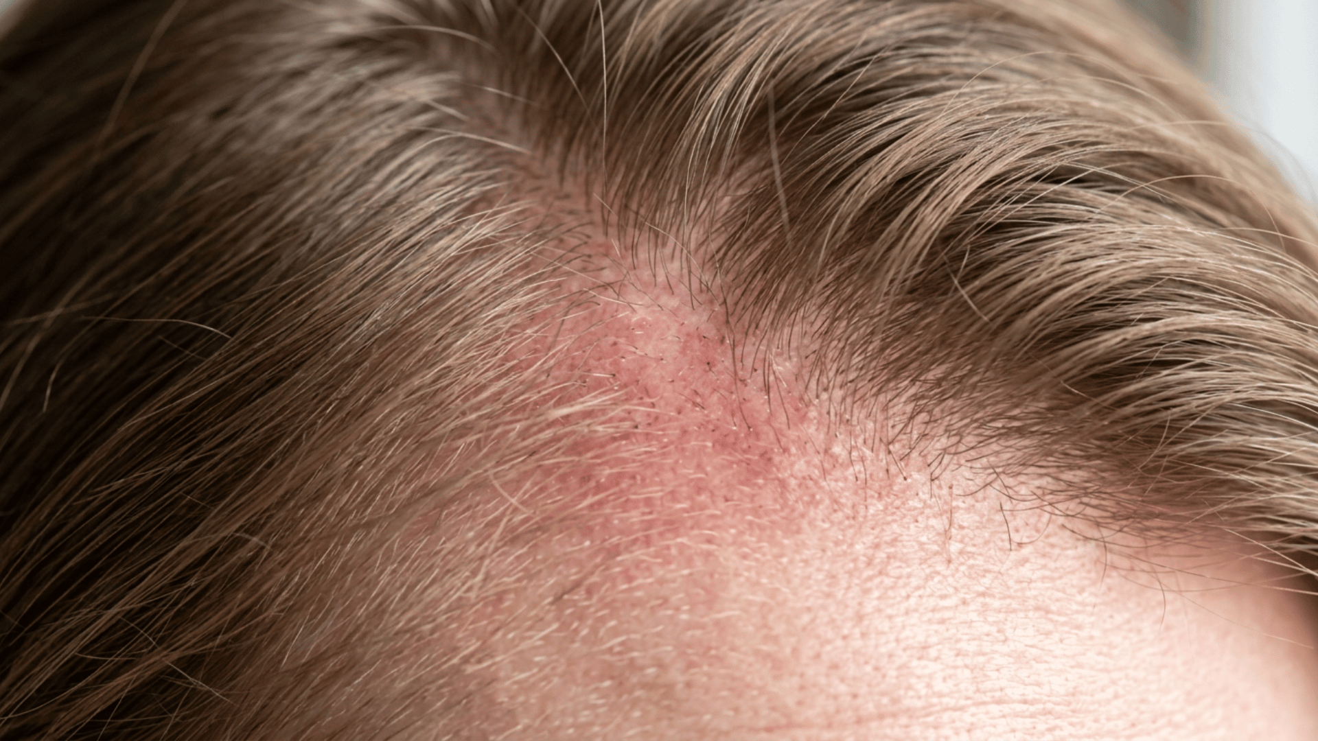 scalp with mild redness shortly after treatment