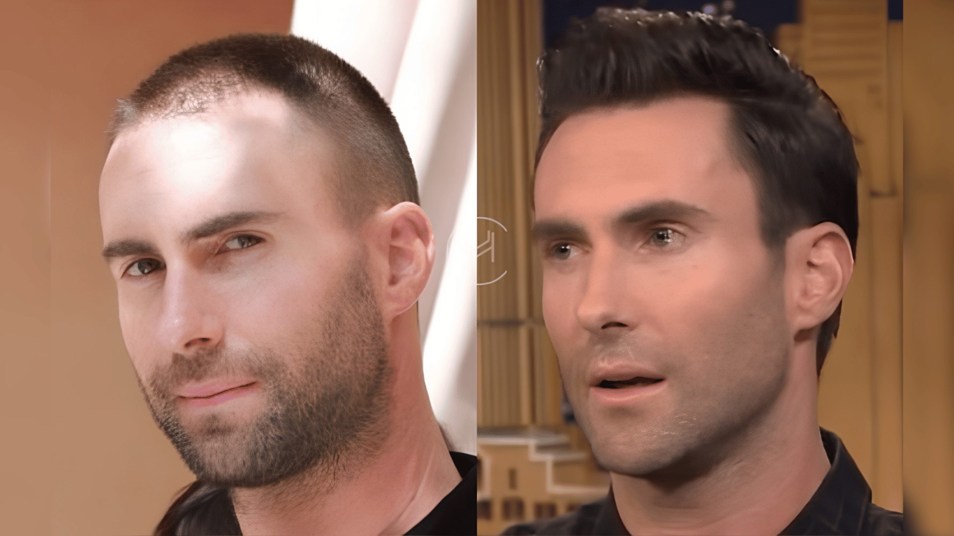 adam levine before and after hair transplant