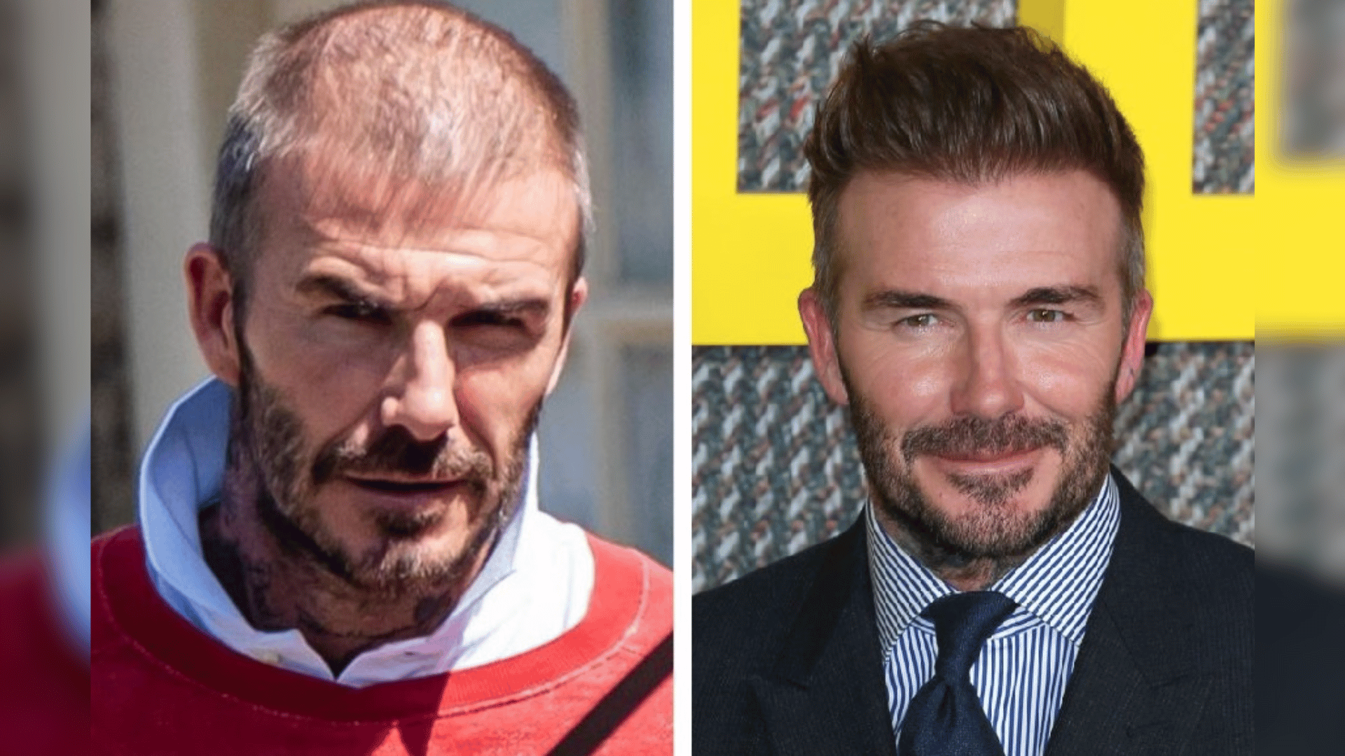 david beckham before and after hair transplant