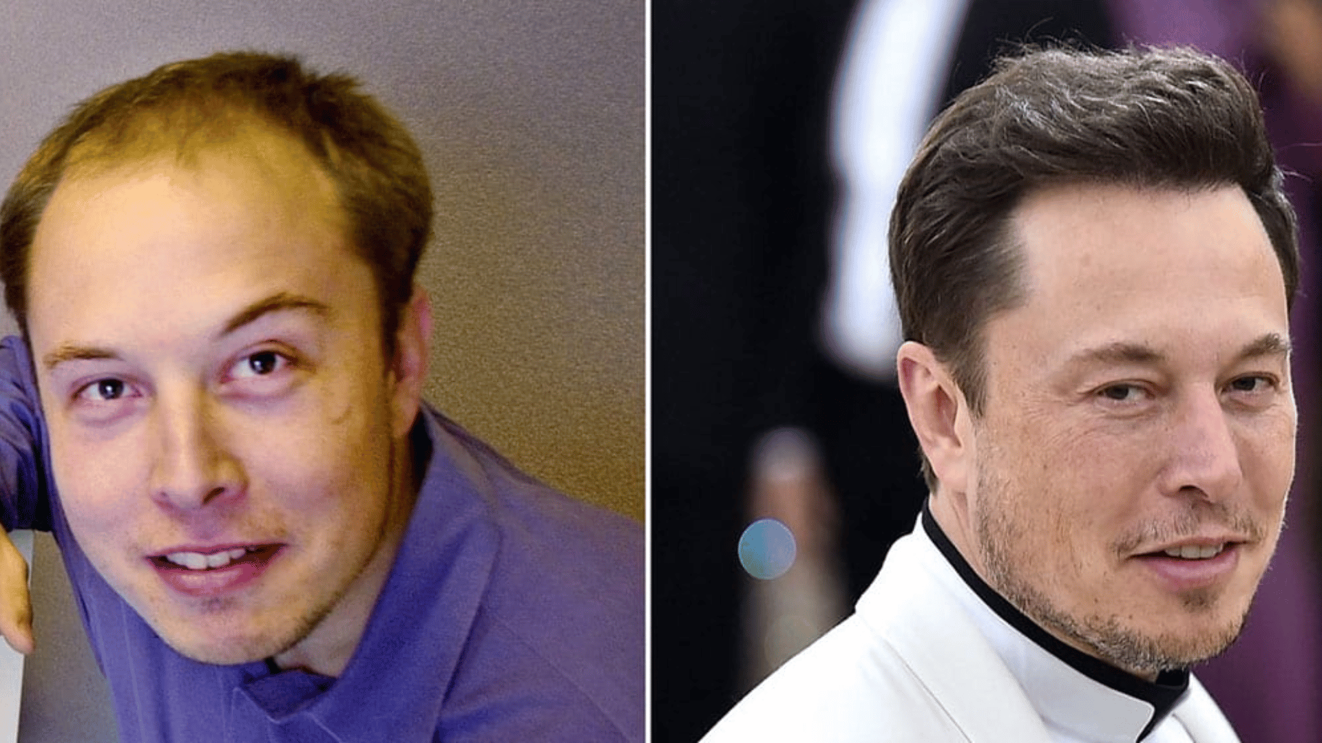 elon musk before and after hair transplant
