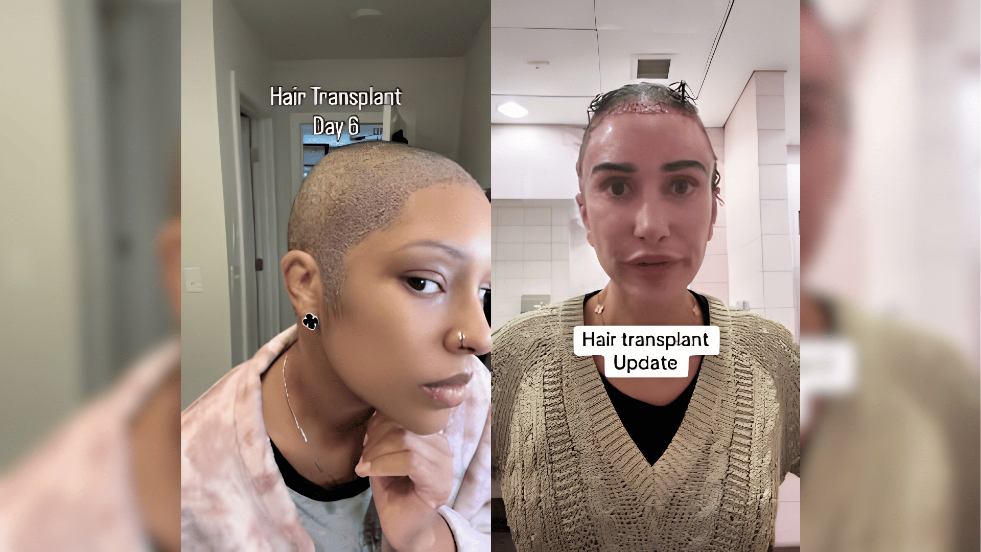 emily abraham instangram and tiktok screenshots showing her hair transplant journey