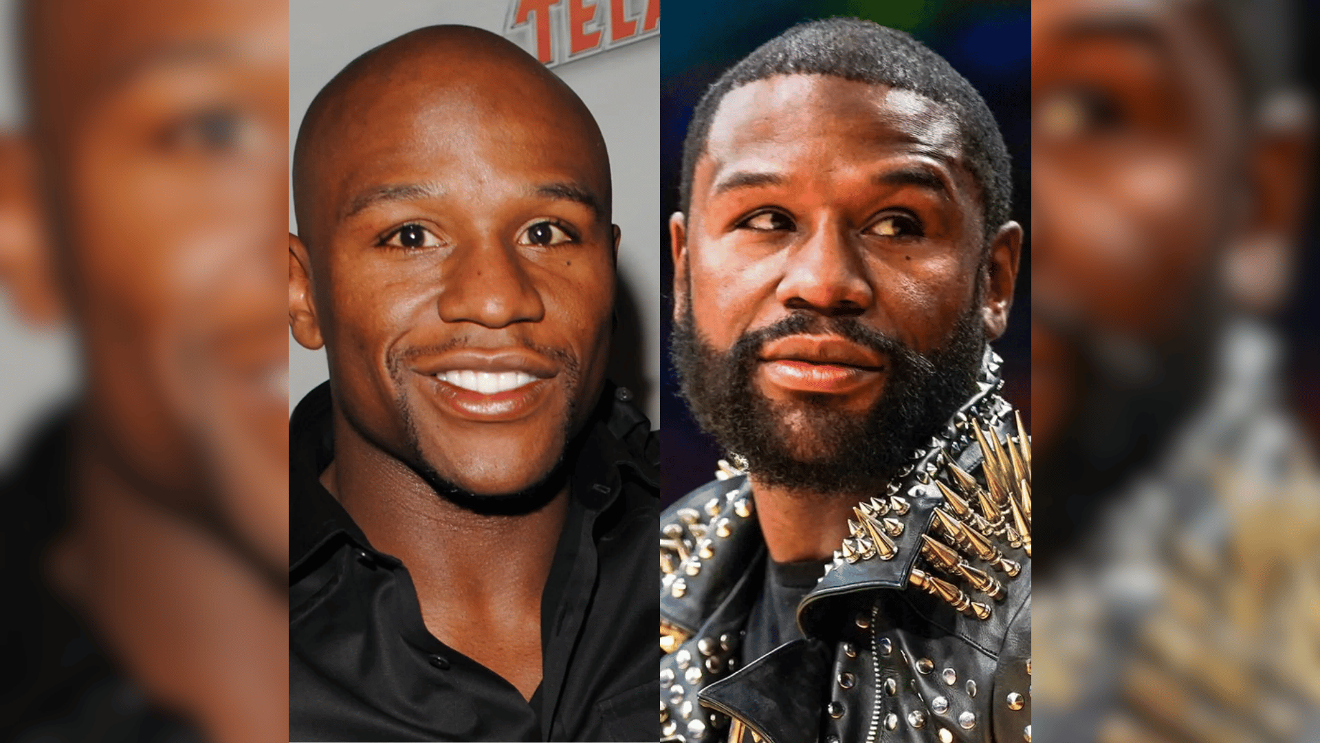floyd mayweather before and after hair transplant