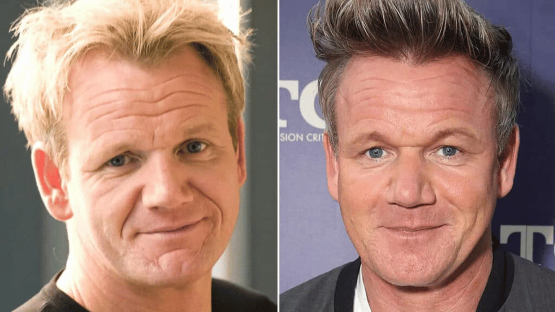 gordon ramsey before and after hair transplant