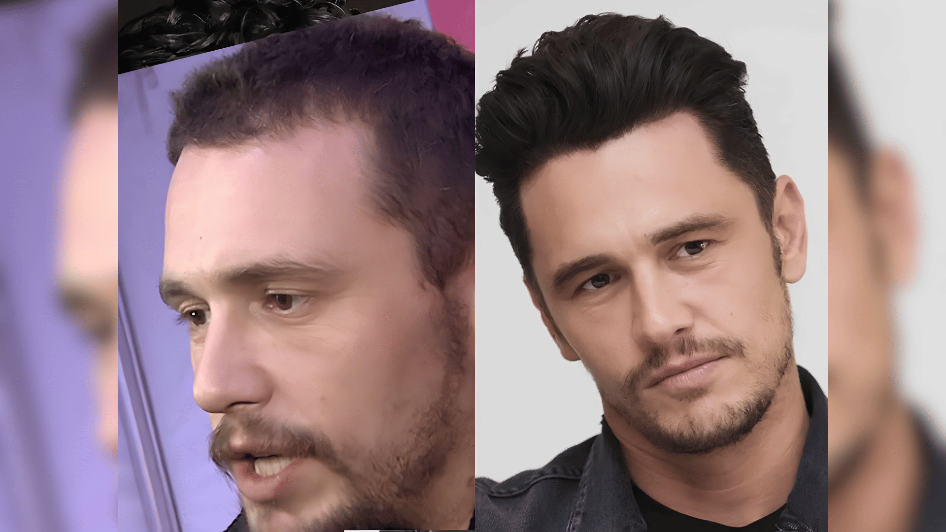 james franco before and after hair transplant