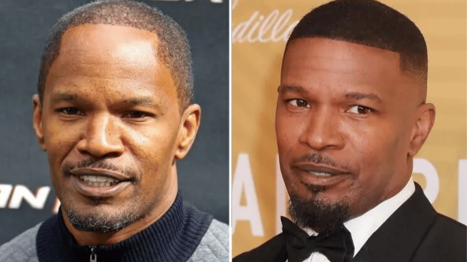 jamie foxx before and after hair transplant