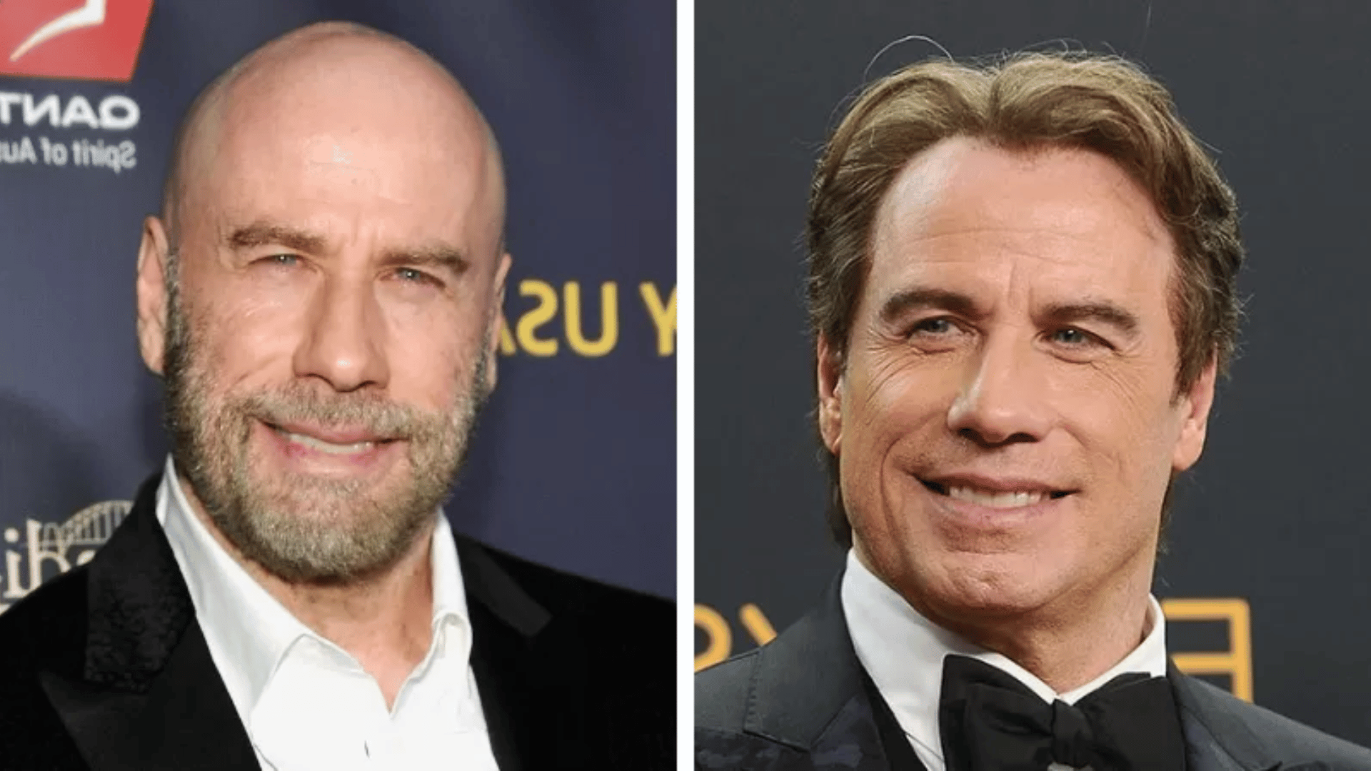 john travolta before and after hair transplant
