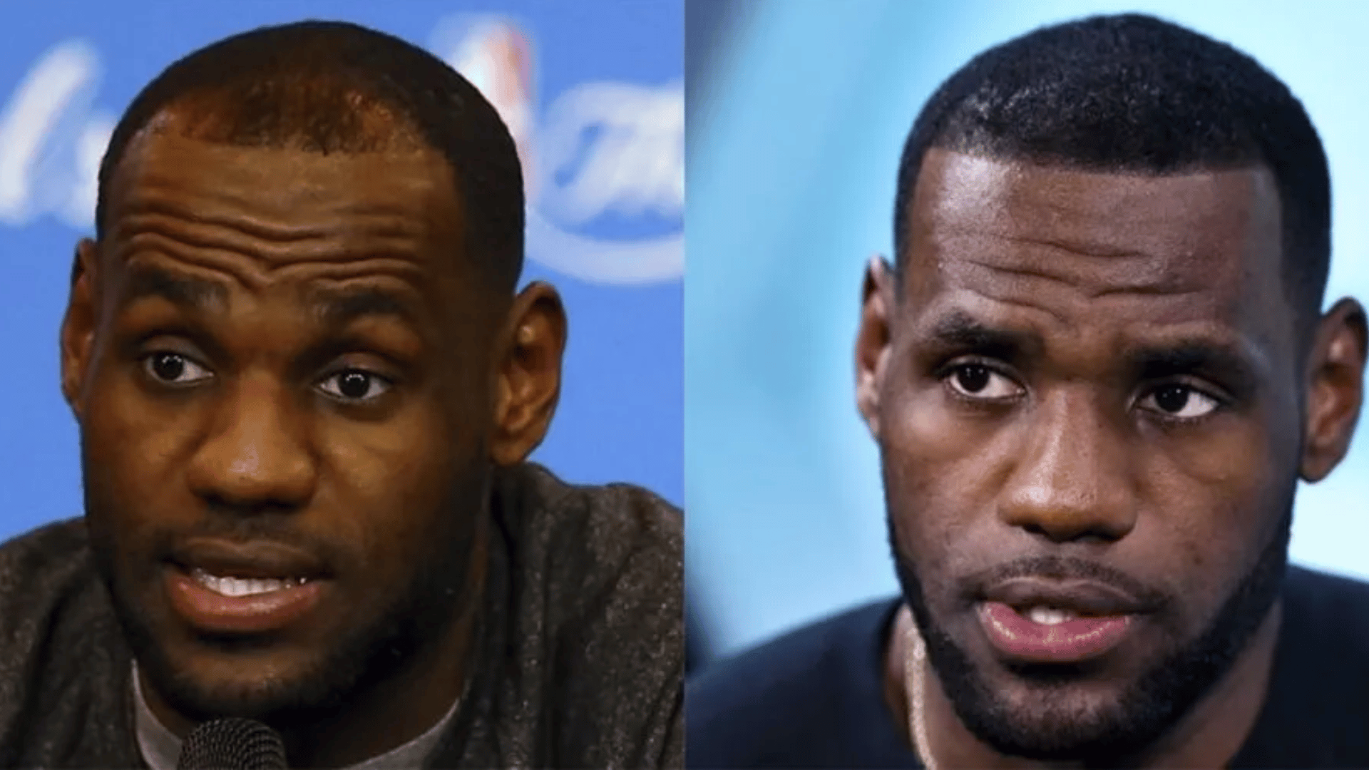 lebron james pre and post hair transplant