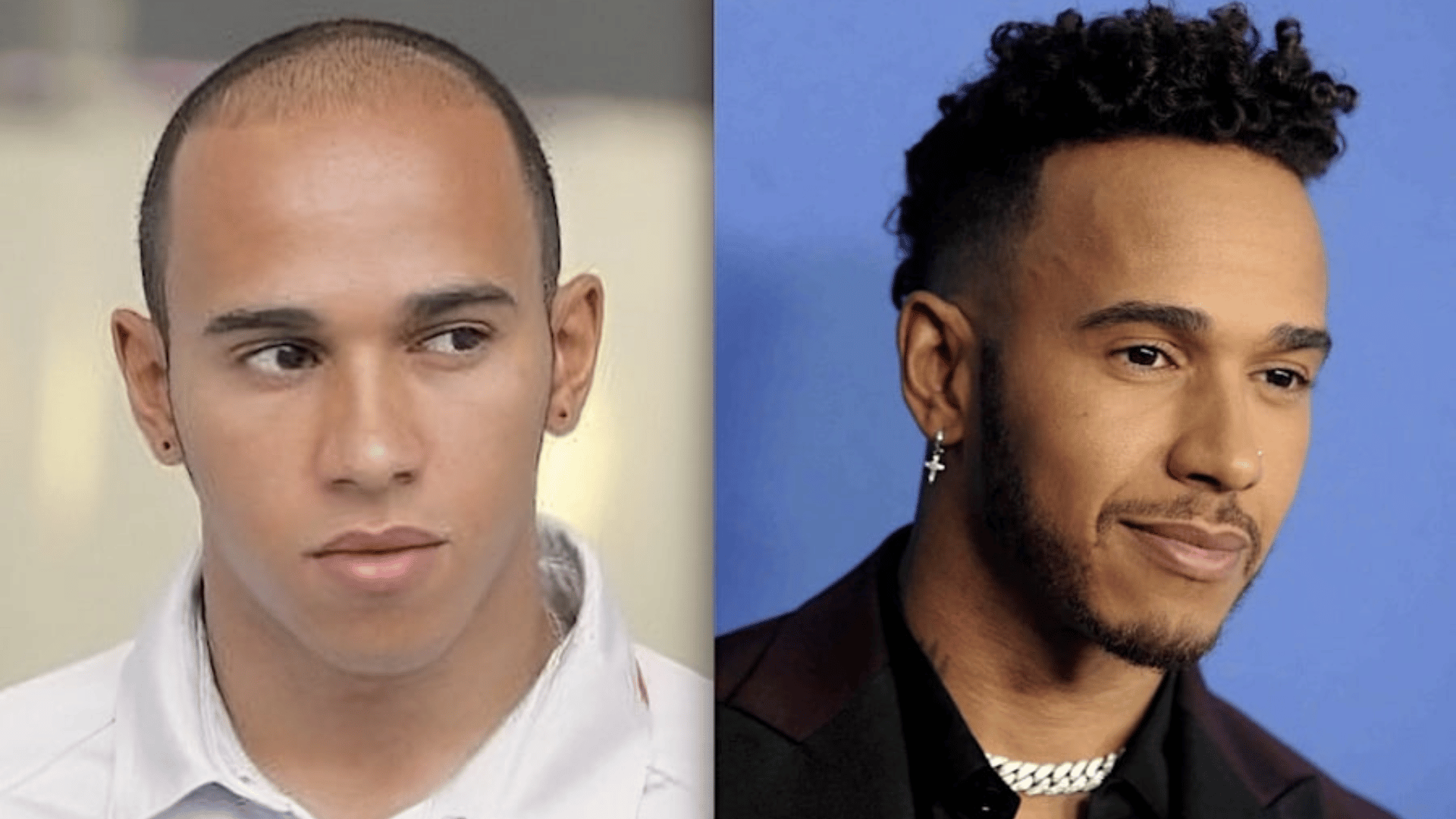 lewis hamilton before and after hair transplant