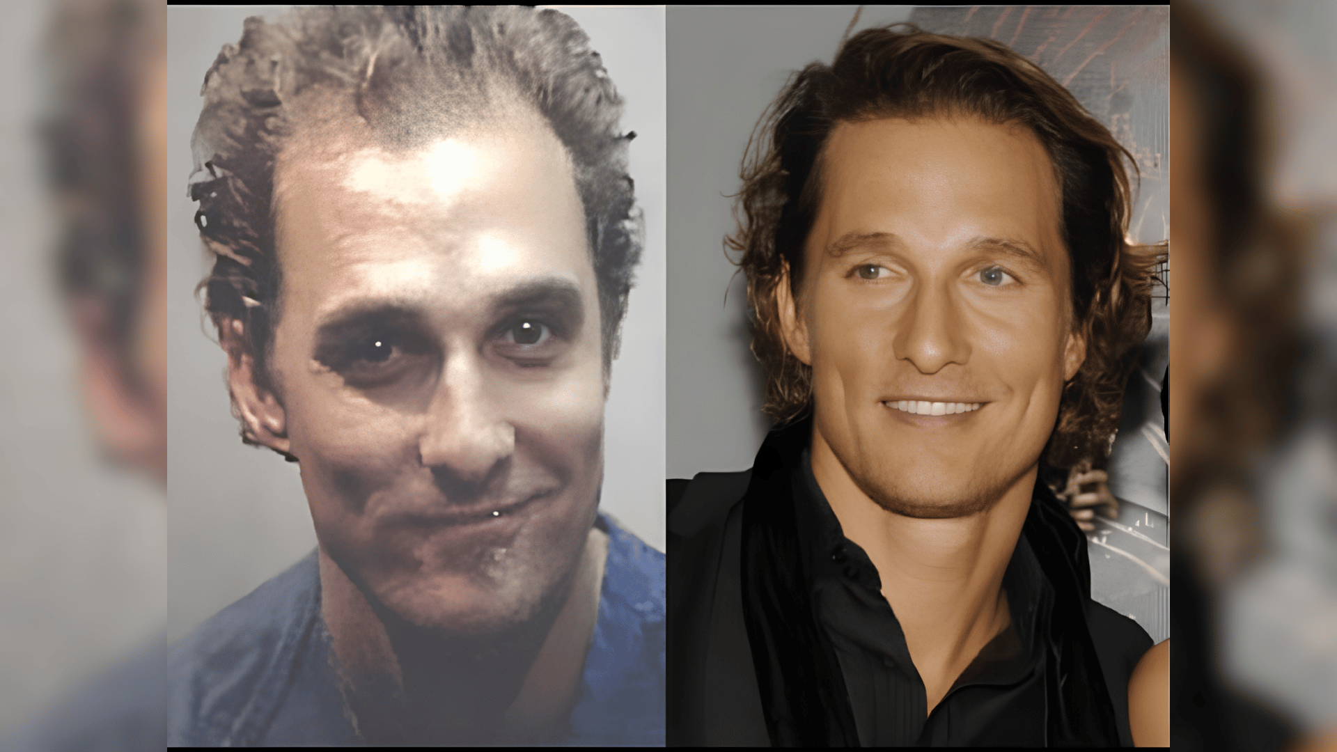 matthew mcconaughey before and after hair transplant