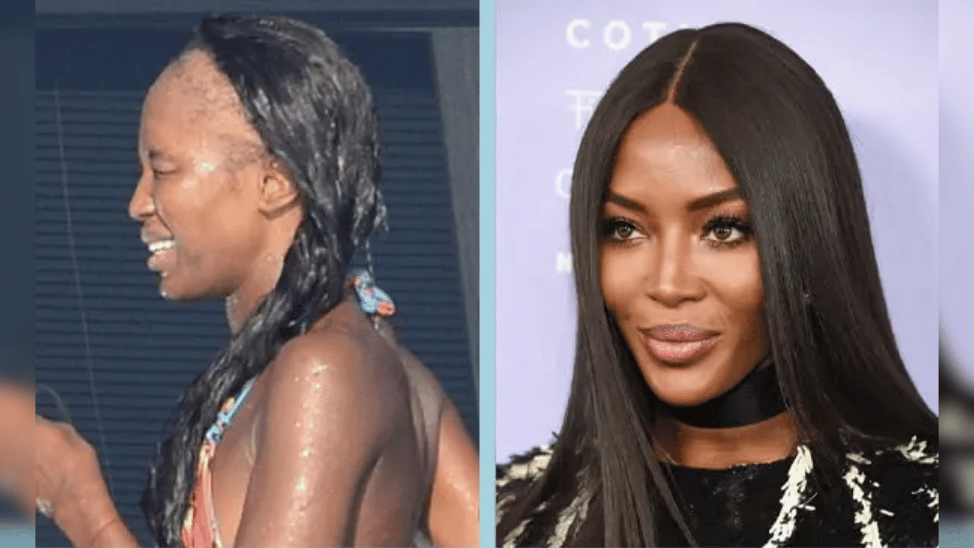 naomi campbell before and after hair transplant