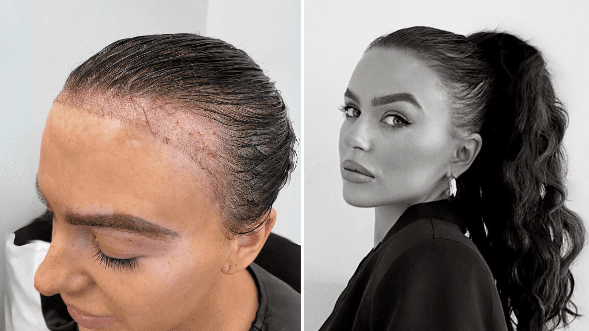 rosie williams before and after hair transplant