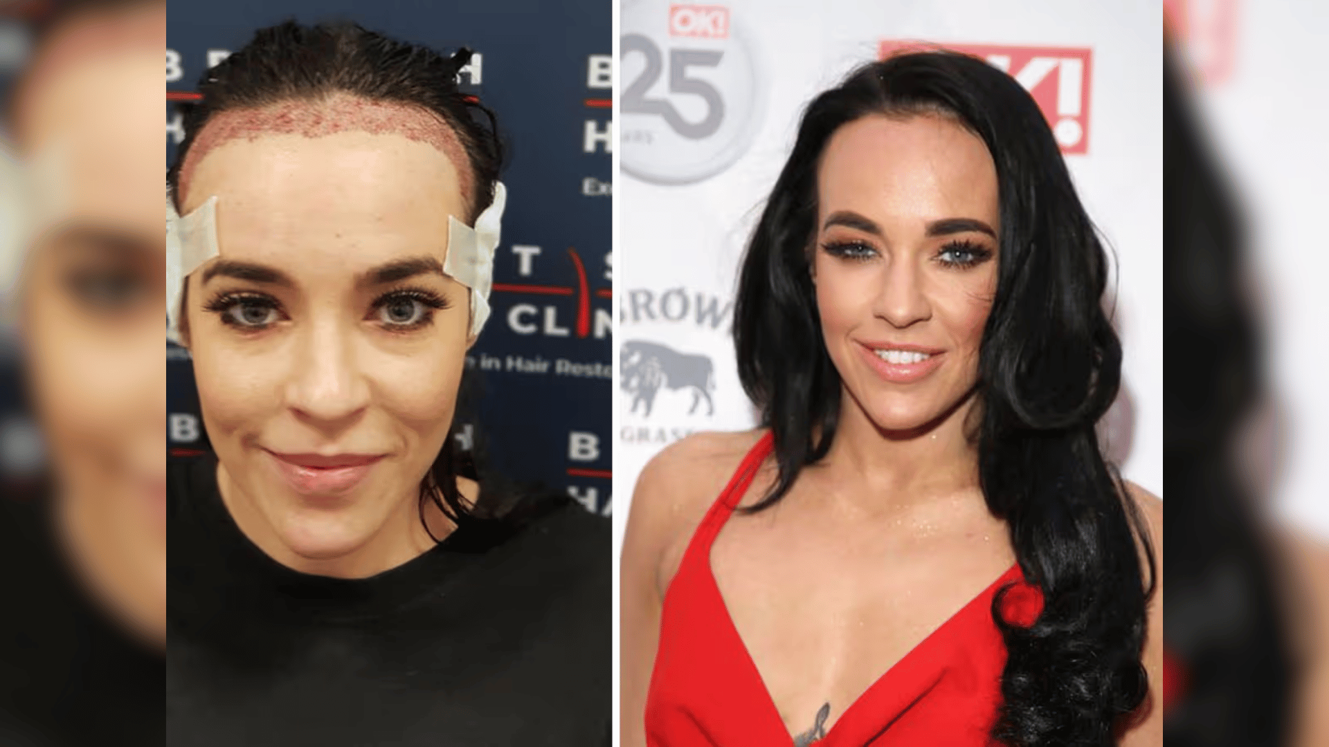 stephanie davis getting transplant on left, results on right