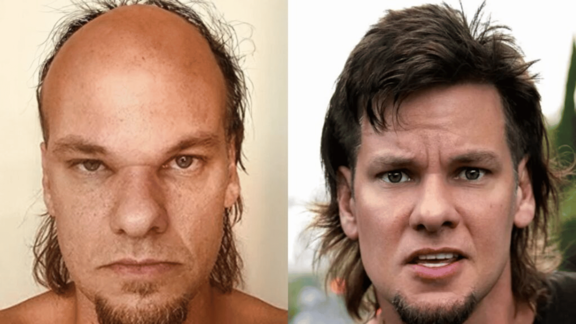 theo von before and after hair transplant