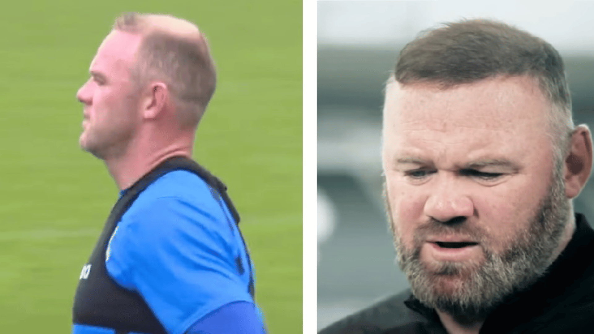wayne rooney before and after hair transplant