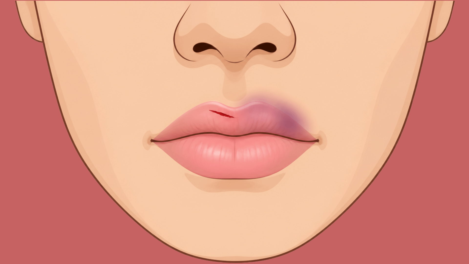 cut and bruising visible on the upper lip