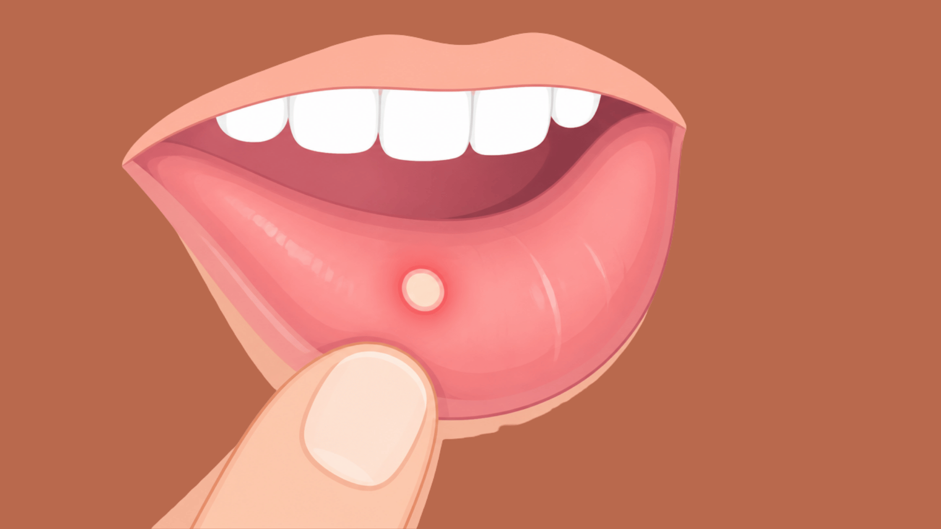 bluish mucocele bump inside the lower lip