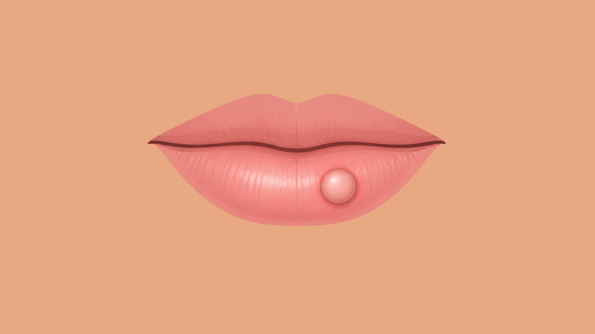 raised skin cyst on the surface of the lower lip