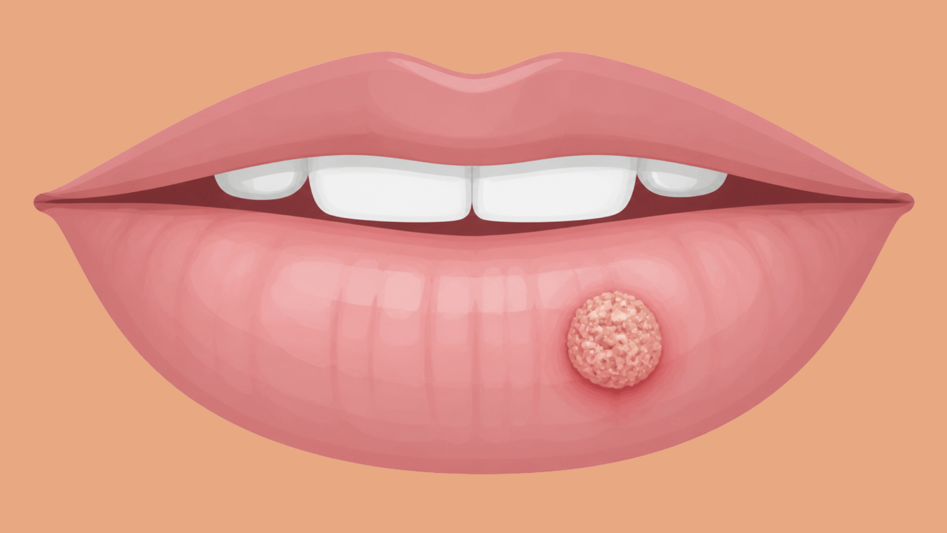 textured wart growing on the lower lip
