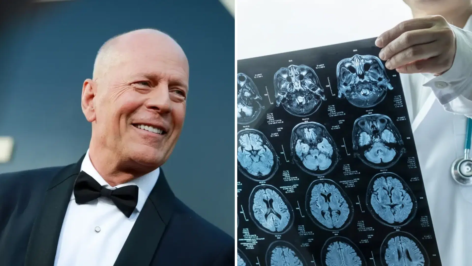 bruce willis portrait beside brain scan images related to health condition and medical discussion